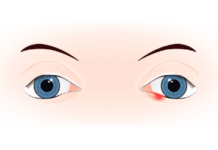 Ячмень — как ускорить выздоровление