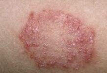 Микробная экзема: причины, диагностика, лечение, микробная экзема у детей, беременных, разновидности, осложнения, консультация дерматолога при микробной экземе