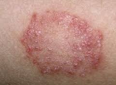 Микробная экзема: причины, диагностика, лечение, микробная экзема у детей, беременных, разновидности, осложнения, консультация дерматолога при микробной экземе