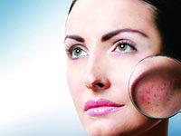 СОВРЕМЕННЫЕ МЕТОДЫ ЛЕЧЕНИЯ АКНЕ