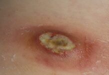 Гнойная рана: причины, симптомы и лечение в статье детского хирурга Богданов С. Г.