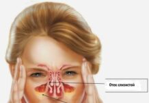 Хронический ринит