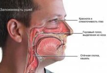 Как вылечить насморк. Препараты от насморка