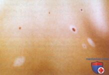 Доброкачественный невус — родинка. Причины появления и диагностика