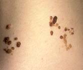 Новообразования кожи – их опасности и удаление