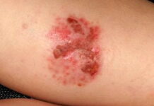 Монетовидная экзема — Европейские рекомендации