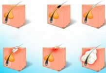 Опасности атеромы на лице. Диагностика и лечение | АТЛАНТиК