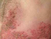 Опоясывающий лишай: причины, симптомы, прогноз — Онлайн-диагностика