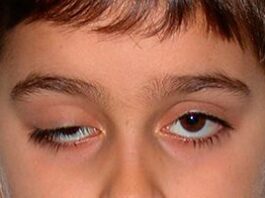 Опущение века (птоз), причины, симптомы, лечение и профилактика в ЦЭЛТ.