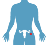 Генитальный герпес!