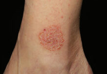 Острая экзема: причины, симптомы и лечение