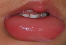 Опухла губа от герпеса — как лечить, фото