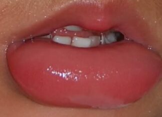 Опухла губа от герпеса — как лечить, фото