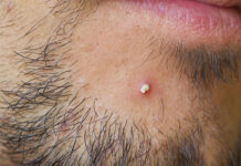 Как отличить фурункул от других кожных образований и заболеваний