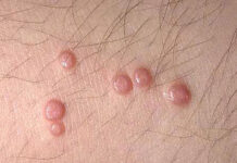 Папулы. Фото и лечение | Морфологические элементы