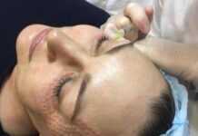 Папулы после биоревитализации (34 фото): сколько дней держатся, почему не проходят и как убрать, что такое папульная техника