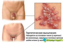 Передается ли герпес с губ на другие части тела