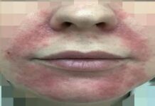 Что такое периоральный дерматит