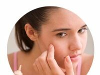 Acne vulgaris (вульгарные угри)