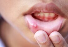 Белые язвочки во рту у ребенка с фото: почему они появляются и как лечить?