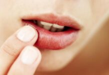 Герпес или простуда на губах — Портал