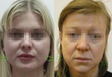 Жировой комок щеки или комок Биша (Bichat). Удаление | 3d пластика (новое в хирургии красоты)