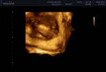 Генитальный герпес во время беременности