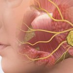 На лице шишка под кожей; причины уплотнения и как избавится