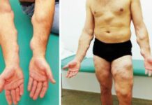 Почему появляются жировики и шишки по всему телу? | АТЛАНТиК