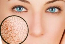 Если кожа на лице шелушится, что делать? Причины шелушения и способы его устранения; ЭЛ Клиника