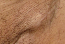 Шарик в паховой области: фото, возможные болезни, лечение | Наросты на коже