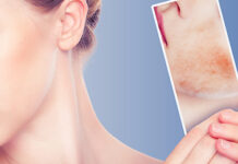 Покраснение и шелушение кожи лица. Почему, Как бороться? | Официальный сайт препарата Цинокап