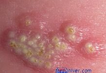 Генитальный или половой герпес. Можно ли заразиться генитальным герпесом при поцелуе?