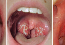 Язвы в горле: возникновение и причины, проявления, диагностика, принципы лечения
