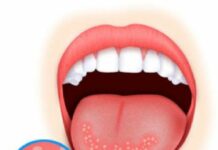 Язвы в горле — причины появления и методы лечения