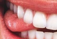 Что делать, когда сильно прикусил язык и он болит – обезболивание и дезинфекция, лечение раны народными средствами и аптечными препаратами. Оказание первой помощи ребенку