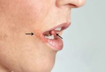 Герпетический стоматит: причины, симптомы и лечение в статье стоматолога Кожевникова С. Н.