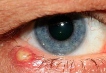 Можно ли красить ресницы когда ячмень на глазу?