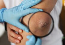 Как отличить псориаз от экземы и как действовать? Все про аллергию