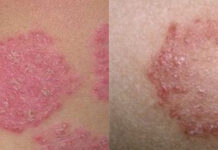 Псориаз и экзема: отличия, причины. О лечении читайте тут!