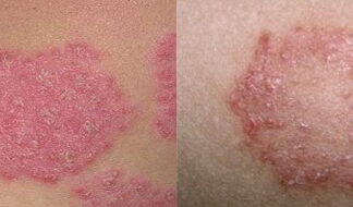 Псориаз и экзема: отличия, причины. О лечении читайте тут!
