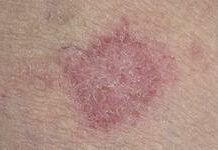 Берут ли в армию с хронической экземой | Экзема и армия