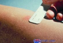 Туберкулез, БЦЖ и Манту. Каким должен быть размер язвочки пробы Манту?