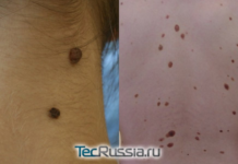 Виды новообразований на коже