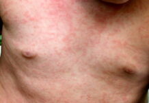 Розеола детская — Клинические рекомендации