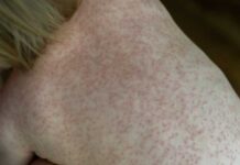 Розеола детская — симптомы, способы передачи заболевания