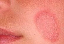 Розовый лишай (болезнь Жибера). Тревожные симптомы и эффективное лечение