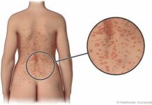 Розовый лишай: причины, симптомы и лечение в статье венеролога Агапов С. А.
