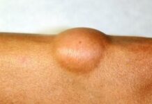 Липома: опасно или нет — блог медицинского центра ОН Клиник