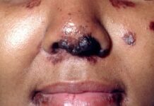 Саркоидоз — Европейские рекомендации